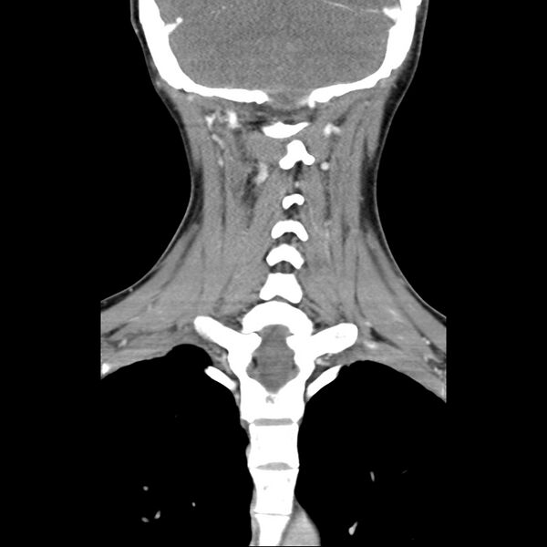 File:Normal CT of the neck (Radiopaedia 14575-14500 Coronal C+ 41).jpg