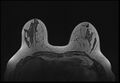 Normal breast MRI - dense breasts (Radiopaedia 80454-93850 Axial T1 73).jpg
