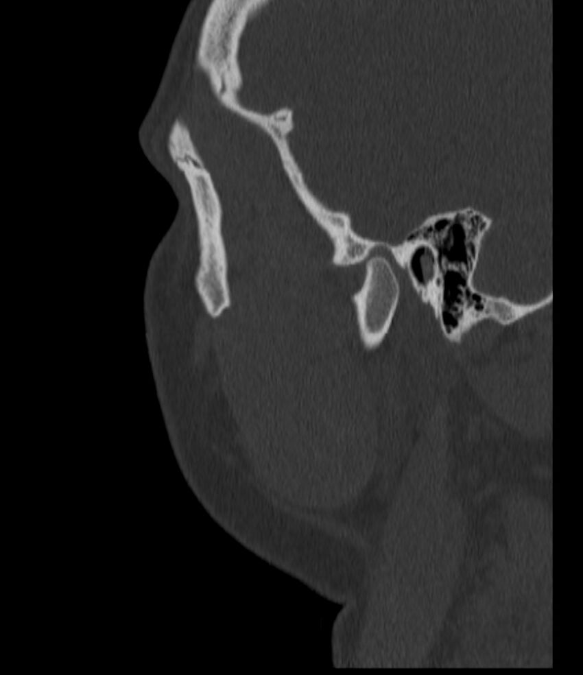 Normal facial bone CT (Radiopaedia 88742-105476 Sagittal bone window 139).jpg