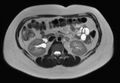 Normal liver MRI with Gadolinium (Radiopaedia 58913-66163 Axial T2 11).jpg