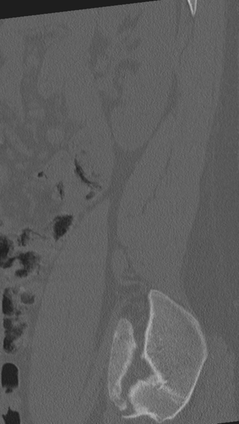 File:Normal lumbar spine CT (Radiopaedia 46533-50986 Sagittal bone window 12).png
