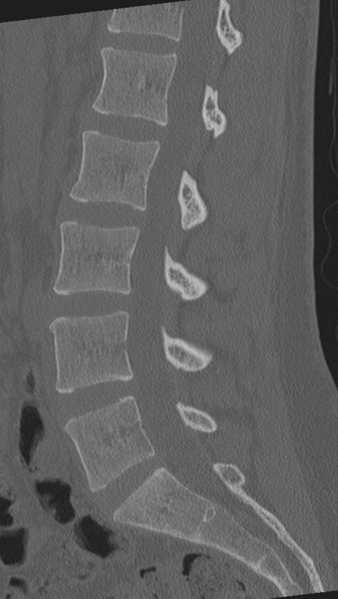 File:Normal lumbar spine CT (Radiopaedia 46533-50986 Sagittal bone window 48).png