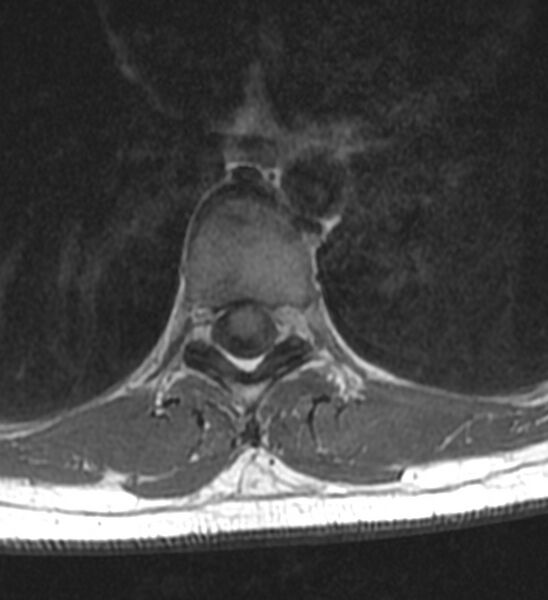 File:Normal thoracic spine MRI (Radiopaedia 41033-43781 Axial T1 7).jpg