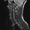 Normal trauma cervical spine (Radiopaedia 41017-43762 Sagittal T2 14).png