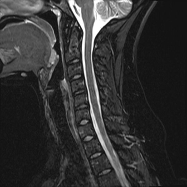 File:Normal trauma cervical spine MRI (Radiopaedia 32130-33071 Sagittal STIR 7).jpg