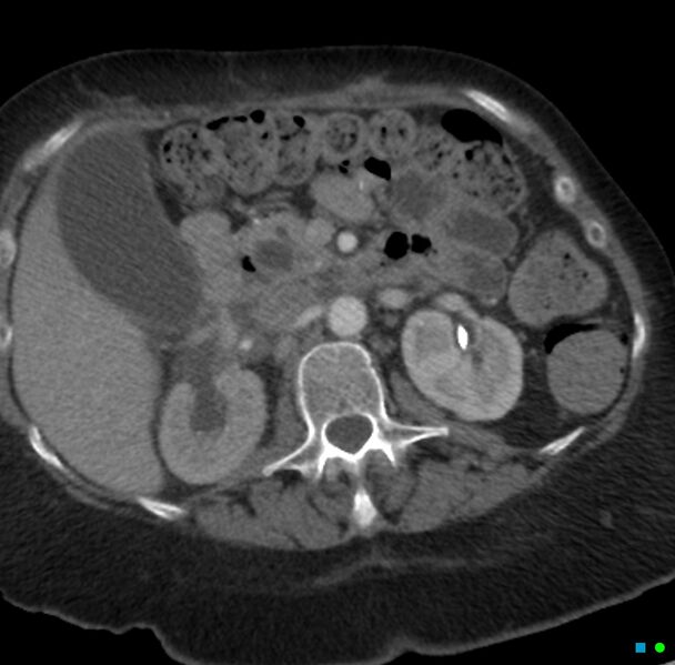 File:Obstructed infected horseshoe kidney (Radiopaedia 18116-17898 B 6).jpg