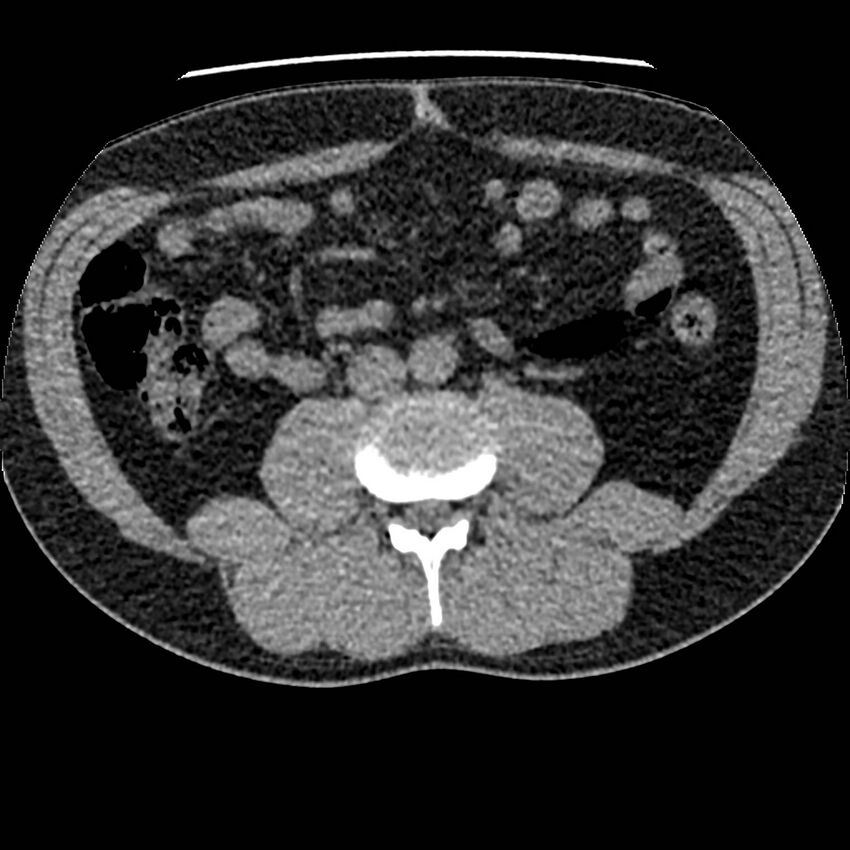 Obstructing ureteric calculus and ureteric anatomy (Radiopaedia 62730-71042 Axial non-contrast 72).jpg