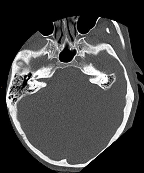 File:Occipital condyle fracture (Radiopaedia 61165-69056 D 1).jpg