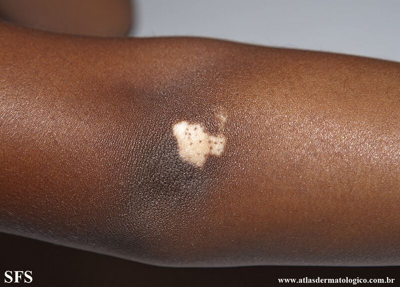 File:Vitiligo (Dermatology Atlas 69).jpg