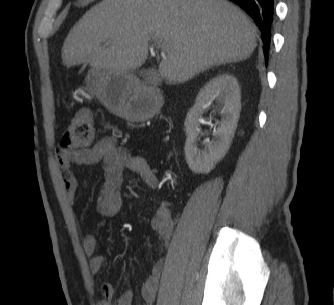 File:Abdominal aortic aneurysm (Radiopaedia 22421-22458 D 7).jpg