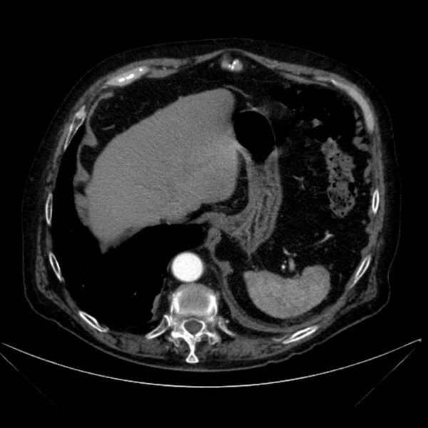 File:Abdominal aortic aneurysm (Radiopaedia 25855-26001 Axial C+ arterial phase 27).jpg