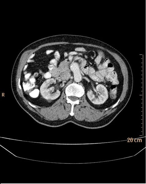 File:Abdominal aortic aneurysm (Radiopaedia 25985-26121 Axial C+ arterial phase 9).jpg