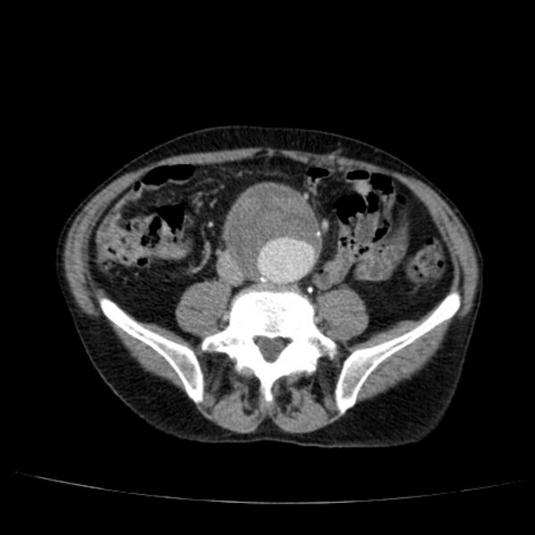 File:Abdominal aortic aneurysm (Radiopaedia 29248-29660 Axial C+ portal venous phase 39).jpg