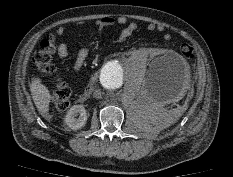 File:Abdominal aortic aneurysm rupture (Radiopaedia 54179-60362 Axial C+ arterial phase 32).jpg