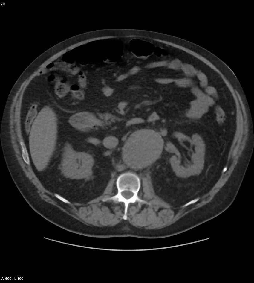 Abdominal aortic aneurysm with intramural hematoma then rupture (Radiopaedia 50278-55631 Axial non-contrast 66).jpg