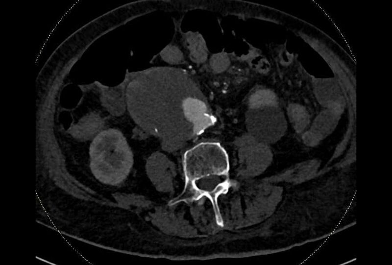 File:Abdominal aortic aneurysm with thrombus fissuration (Radiopaedia 73192-83919 Axial C+ arterial phase 126).jpg