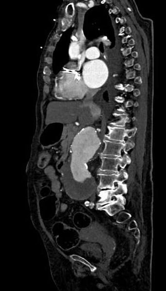 File:Abdominal aortic aneurysm with thrombus fissuration (Radiopaedia 73192-83919 Sagittal C+ arterial phase 77).jpg