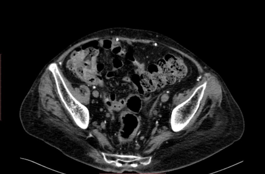 Abdominal aortic interposition tube graft and aneurysm thrombosis (Radiopaedia 71438-81857 Axial C+ arterial phase 191).jpg