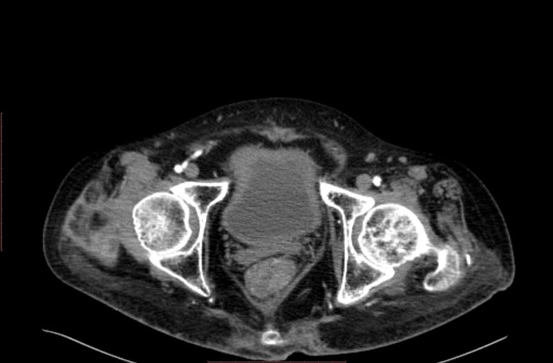 File:Abdominal aortic interposition tube graft and aneurysm thrombosis (Radiopaedia 71438-81857 Axial C+ arterial phase 232).jpg