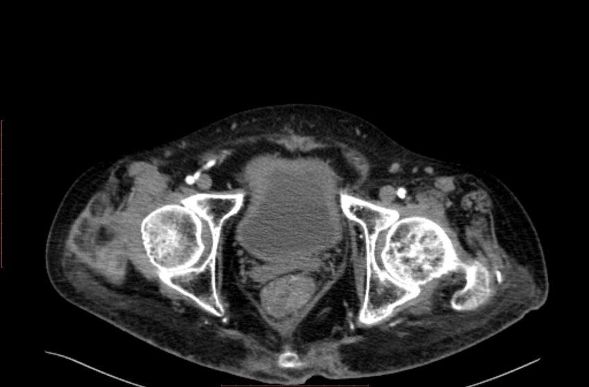Abdominal aortic interposition tube graft and aneurysm thrombosis (Radiopaedia 71438-81857 Axial C+ arterial phase 232).jpg