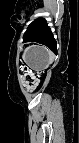 File:Abdominal hydatid disease (Radiopaedia 68223-77737 Sagittal C+ portal venous phase 8).jpg