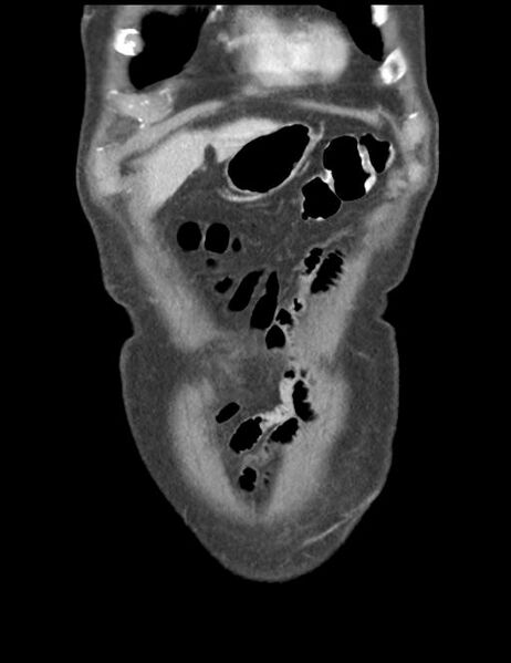 File:Abdominal wall metastasis from colorectal carcinoma (Radiopaedia 31016-31717 Coronal C+ portal venous phase 7).jpg