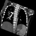 Aberrant left pulmonary artery (pulmonary sling) (Radiopaedia 42323-45435 Coronal C+ CTPA 9).jpg
