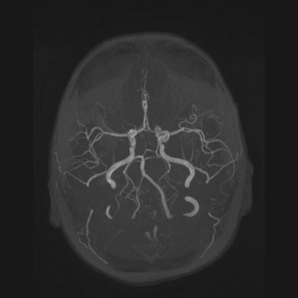 File:Accessory middle cerebral artery and ICA aneurysm (Radiopaedia 22656-22674 B 14).jpg