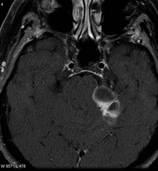 File:Acoustic schwannoma (large with cystic change) (Radiopaedia 5369-7130 Axial T1 C+ fat sat 2).jpg