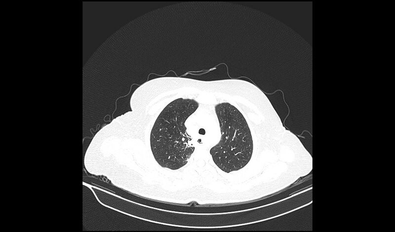 File:Acquired tracheo-esophageal fistula (Radiopaedia 51356-57103 Axial lung window 10).jpg