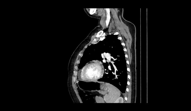 File:Acquired tracheo-esophageal fistula (Radiopaedia 51356-57103 Sagittal C+ arterial phase 3).jpg