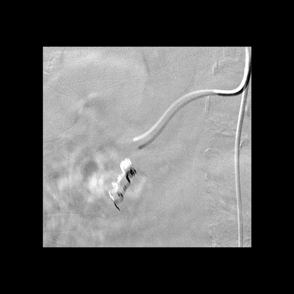 File:Active bleeding from duodenal ulcer with embolization (Radiopaedia 34216-35484 Frontal Gastroduodenal artery (post-coiling) 4).png