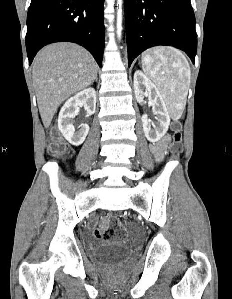 File:Active crohn disease (Radiopaedia 87133-103397 Coronal C+ arterial phase 44).jpg