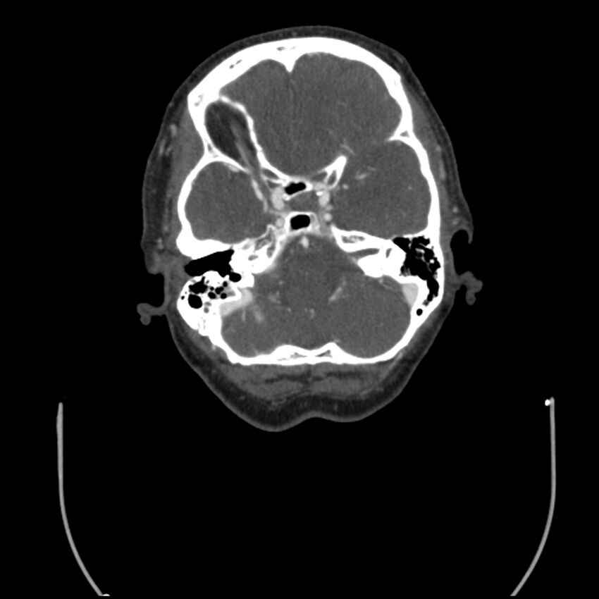 Acute M1 occlusion with ischemic penumbra (CT perfusion) (Radiopaedia 71897-82344 Axial C+ arterial phase thins 116).jpg