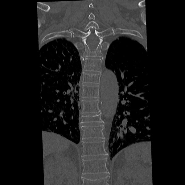 File:Acute and chronic vertebral compression fractures (Radiopaedia 31608-32494 Coronal bone window 22).jpg
