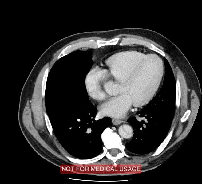 File:Acute aortic dissection - Stanford type A (Radiopaedia 40661-43285 Axial C+ portal venous phase 36).jpg