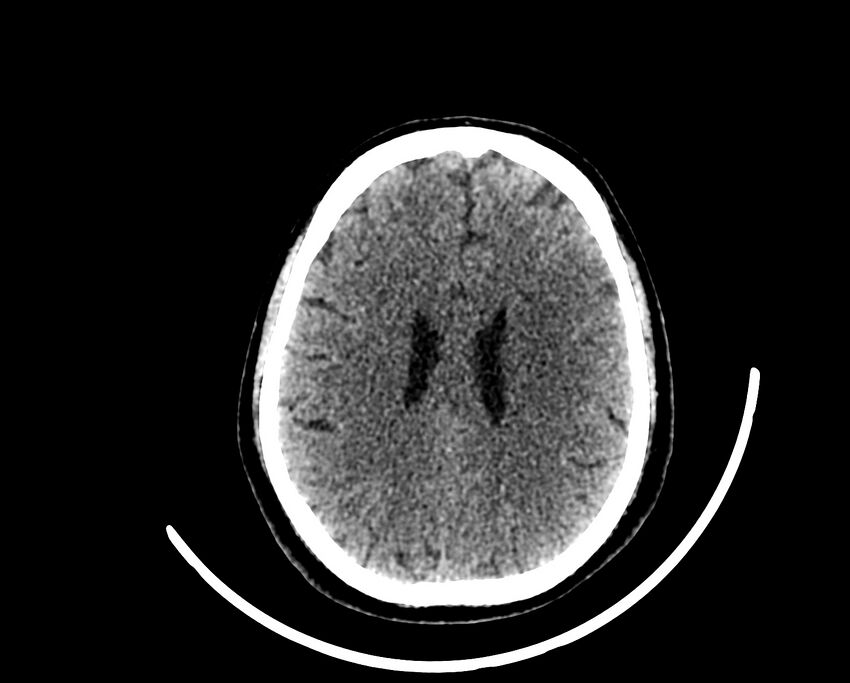 Acute cerebral infarct (Radiopaedia 35604-37123 Axial non-contrast 68).jpg