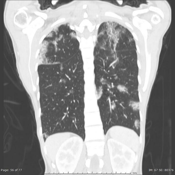 File:Acute eosinophilic pneumonia (Radiopaedia 48211-53073 Coronal 24).jpg