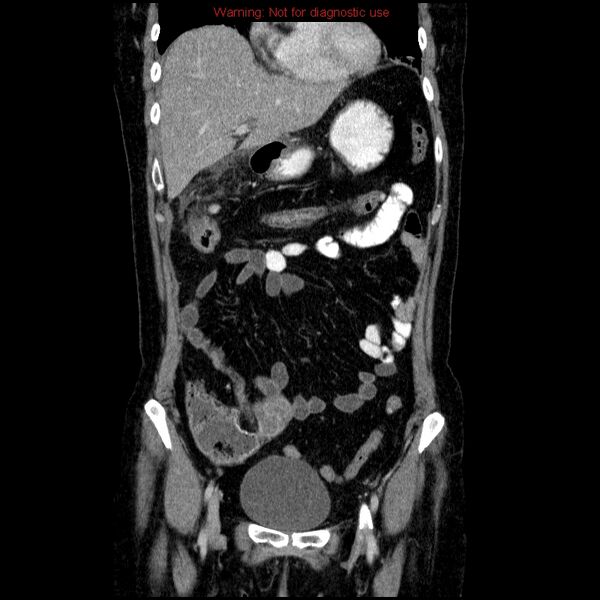 File:Acute gangrenous cholecystitis (Radiopaedia 10123-10661 Coronal C+ portal venous phase 2).jpg