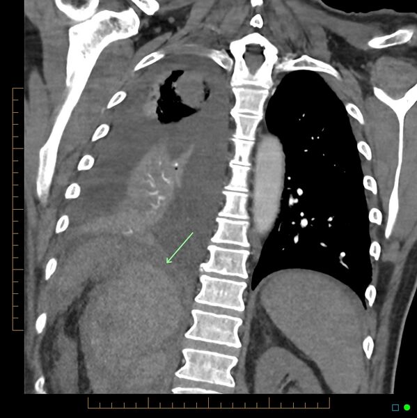 File:Acute hemorrhage into adrenal metastasis from NSCLC (Radiopaedia 43135-46429 Coronal C+ CTPA 1).jpg