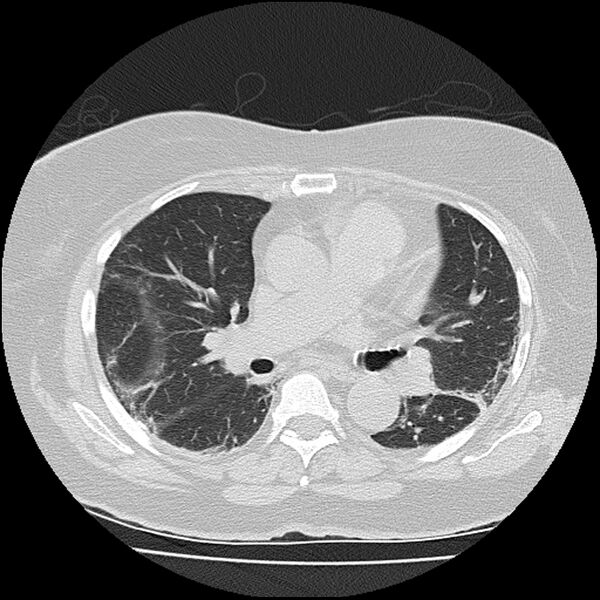 File:Acute interstitial pneumonitis (Radiopaedia 45404-49452 Axial lung window 46).jpg