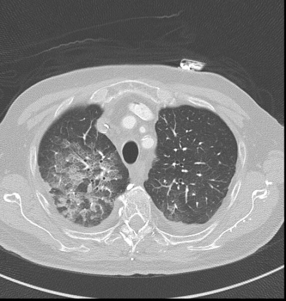 File:Acute myocardial infarction (Radiopaedia 23413-23481 lung window 1).jpg