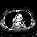 Acute myocardial infarction in CT (Radiopaedia 39947-42415 Axial C+ arterial phase 70).jpg
