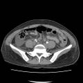 Acute myocarditis (Radiopaedia 55988-62613 Axial C+ portal venous phase 52).jpg