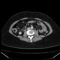 Acute pancreatitis - Balthazar C (Radiopaedia 26569-26714 Axial C+ portal venous phase 56).jpg