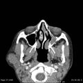 Acute parotitis (Radiopaedia 54123-60294 Axial C+ arterial phase 5).jpg