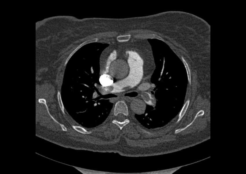 Acute pulmonary embolism (Radiopaedia 29938-30466 Axial C+ CTPA 53).jpg