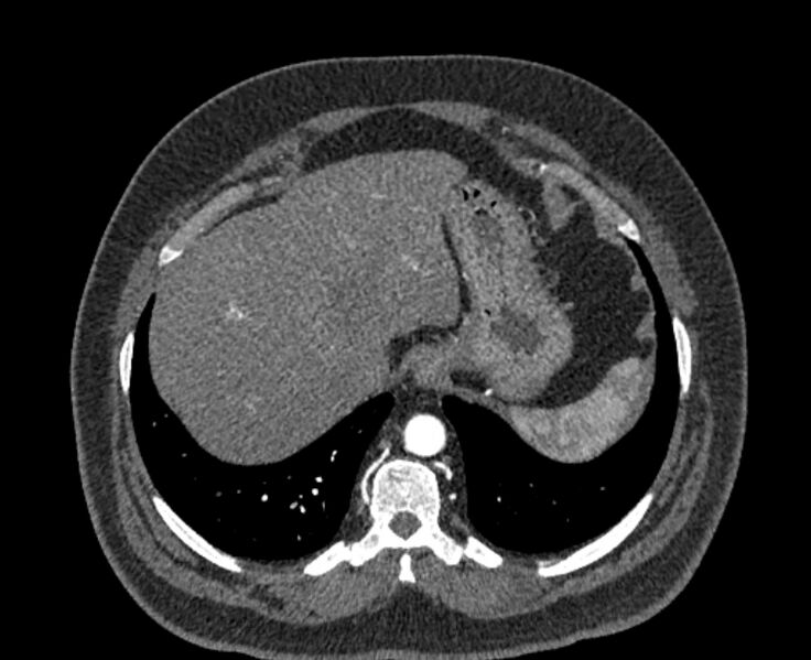 File:Acute pulmonary embolism with pulmonary infarcts (Radiopaedia 77688-89908 Axial C+ CTPA 59).jpg