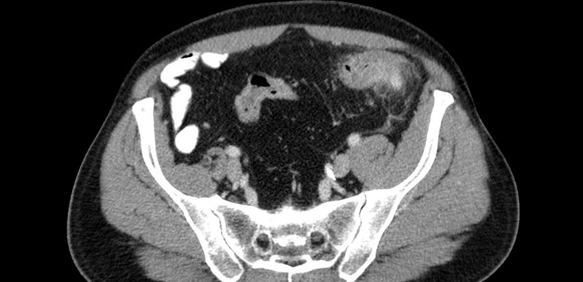 Acute sigmoid colon diverticulitis (Radiopaedia 55507-61976 Axial C+ portal venous phase 78).jpg
