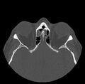 Acute sinusitis (Radiopaedia 23161-23215 Axial bone window 52).jpg